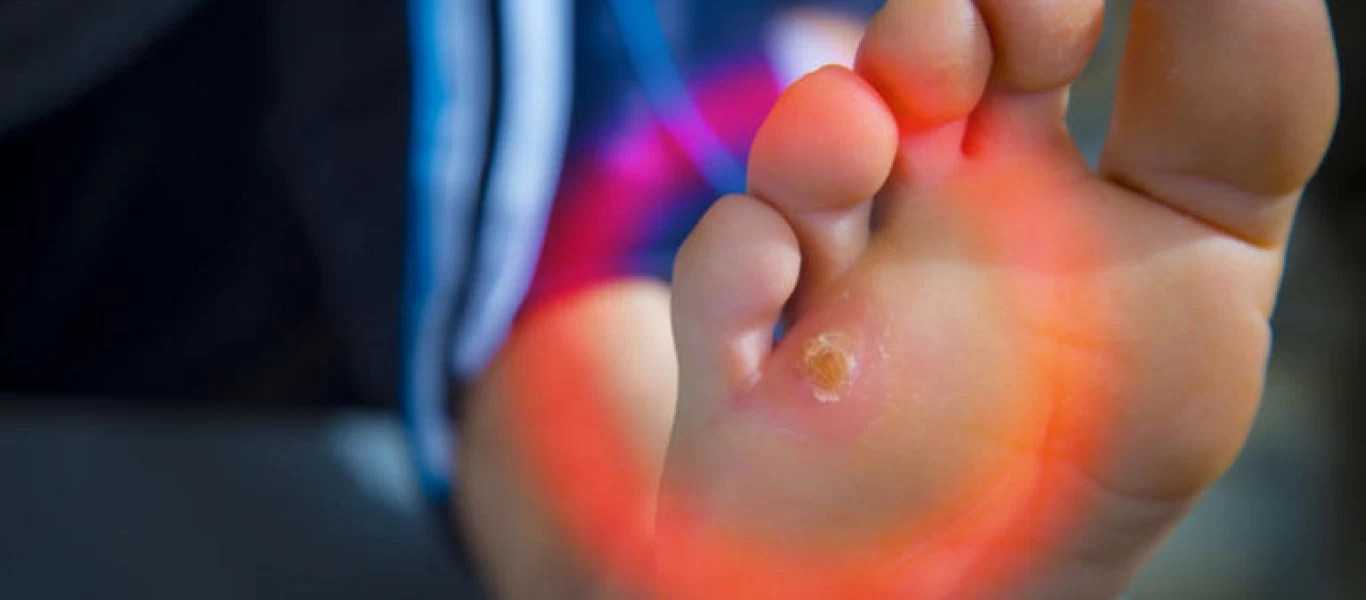 Όσα πρέπει να γνωρίζετε για τους κάλους στα πόδια: Τι να προσέχετε στην αφαίρεσή τους